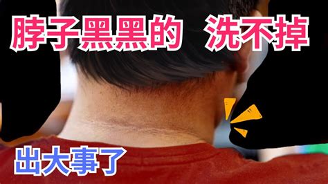 脖子 黑斑|黑色棘皮症讓脖子黑黑的！黑棘皮原因？要看哪一科？。